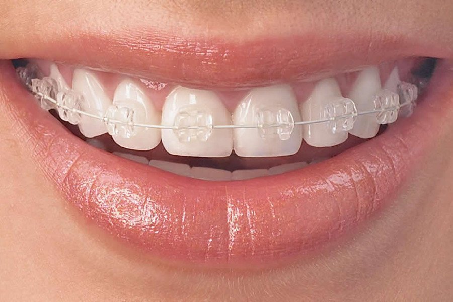 Ορθοδοντική ενηλίκων Orthoclinics